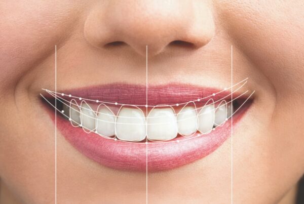 diseño de sonrisa en Castalla