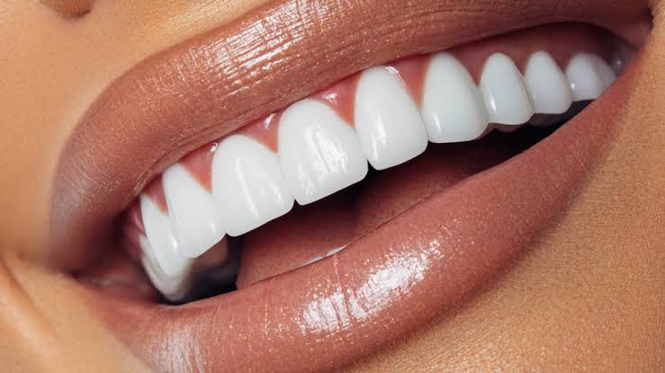 Carillas de porcelana o composite: ¿cuál es mejor? 
